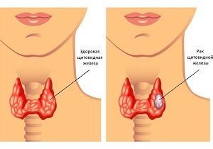 щитовидная железа рак прогноз