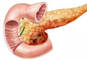 лечение хронического панкреатита