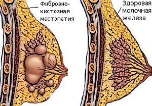 диффузная мастопатия молочной железы