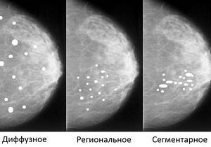 микрокальцинаты молочных желез