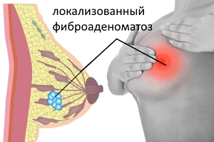 диффузный фиброаденоматоз молочных желез что это такое