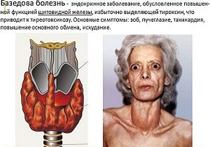 крупская базедова болезнь