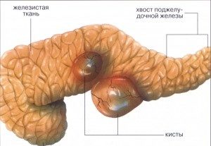 поджелудочная железа киста лечение народными средствами