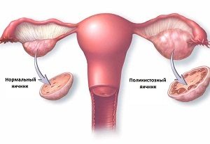 лапароскопия при поликистозе яичников