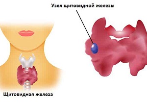 щитовидная железа пункция узла