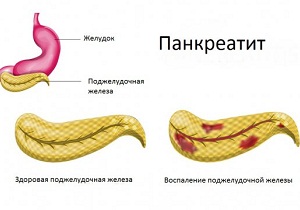 обострение панкреатита лечение