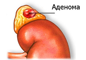 аденома надпочечников у женщин лечение