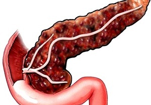хронический панкреатит клинические рекомендации