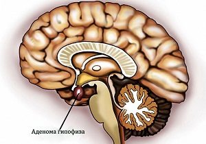 аденома гипофиза головного мозга последствия