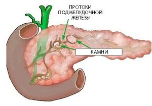 камни в поджелудочной железе лечение без операции