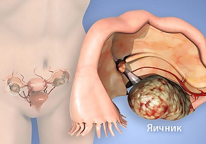 рак яичников симптомы и признаки прогноз