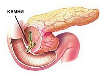 камни в поджелудочной железе