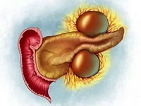 киста поджелудочной железы