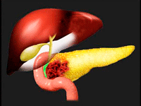 панкреатит лечение