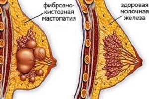 признаки мастопатия молочных желез