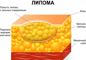 липома фото