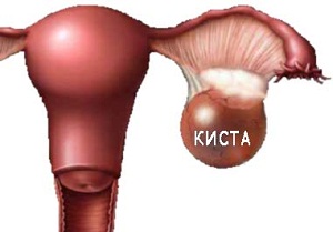 киста правого яичника