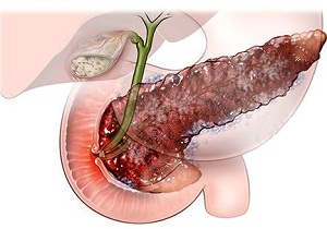 рецепты при панкреатите
