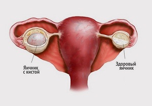 киста яичника симптомы и лечение женщины