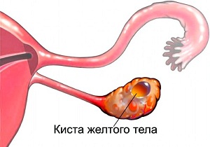 киста левого яичника