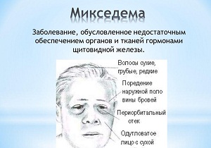 микседема фото