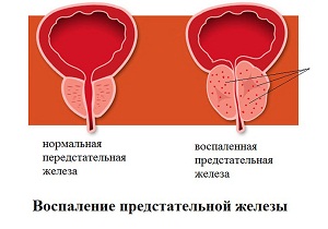 воспаление предстательной железы симптомы