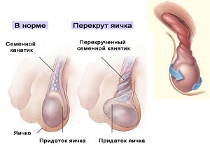 перекрут гидатиды яичка