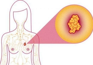 склерозирующий аденоз молочных желез