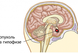 микроаденома гипофиза что это такое