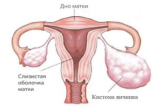 кистома яичника симптомы и лечение женщины