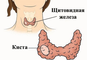 щитовидная железа киста правой доли