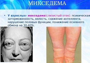 заболевание микседема