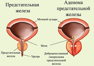 киста предстательной железы у мужчин лечение