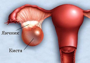 беременность после лапароскопии