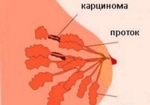 инвазивная карцинома молочной железы неспецифического типа