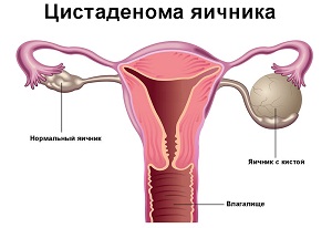 папиллярная цистаденома яичника