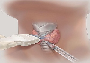щитовидная железа пункция узла