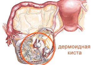 дермоидная киста фото