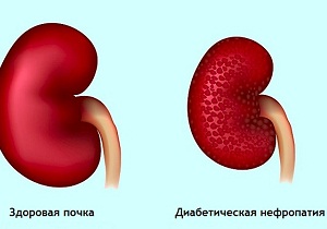 нефропатия при сахарном диабете лечение