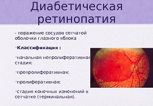 непролиферативная диабетическая ретинопатия