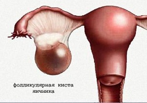 что значит анэхогенное образование