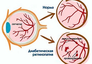 пролиферативная диабетическая ретинопатия