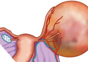 киста яичника фото