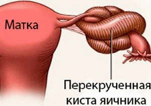 перекрут ножки кисты яичника