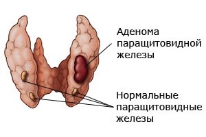 аденома паращитовидной железы