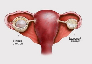 киста правого яичника
