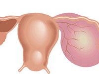 функциональная киста яичника