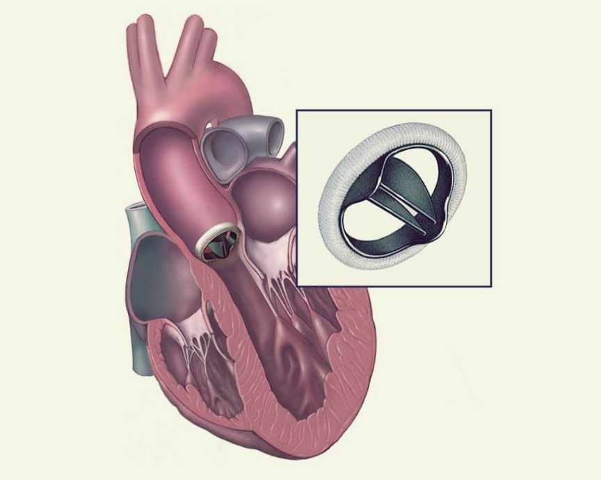 Замена митрального клапана