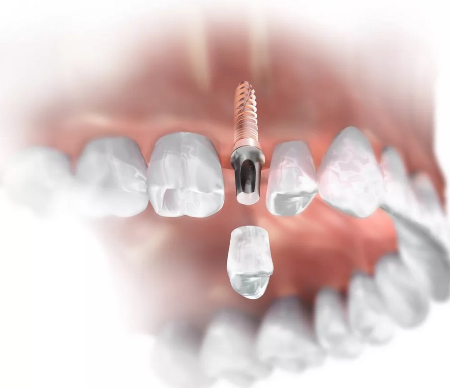 Основные преимущества зубной имплантации