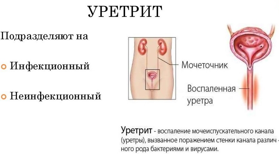 Уретрит: симптомы и лечение